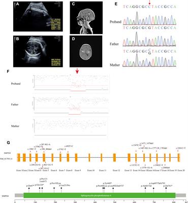 Case Report: Novel Biallelic Null Variants of SMPD4 Confirm Its Involvement in Neurodevelopmental Disorder With Microcephaly, Arthrogryposis, and Structural Brain Anomalies